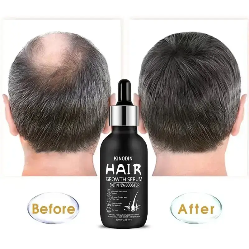 Hair Loss Products for Men Hair Treatment/Hair Growth by Kinodin 5