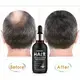 Hair Loss Products for Men Hair Treatment/Hair Growth by Kinodin 5