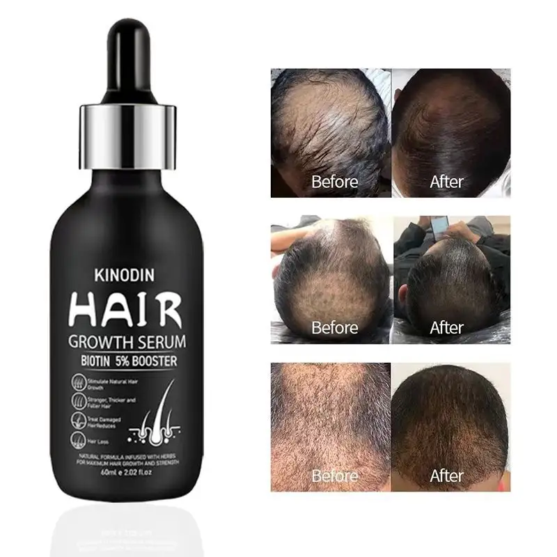 Hair Loss Products for Men Hair Treatment/Hair Growth by Kinodin 6