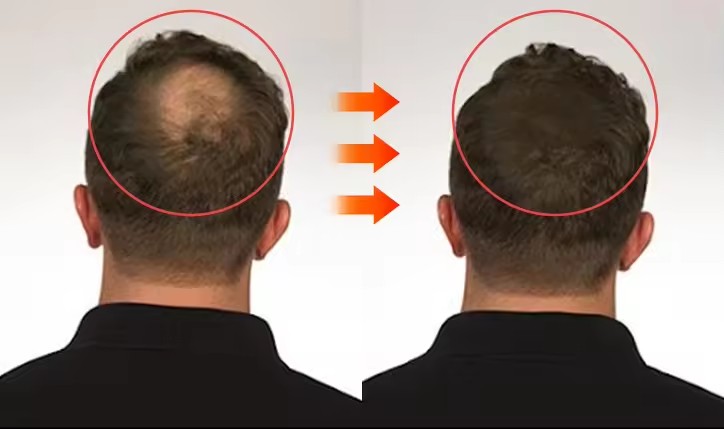 Óleo Capilar Orgânico de Alecrim e Rícino KINODIN para Crescimento e Cuidado do Couro Cabeludo – Tratamento 100% Puro com Vitamina E para Homens e Mulheres 6