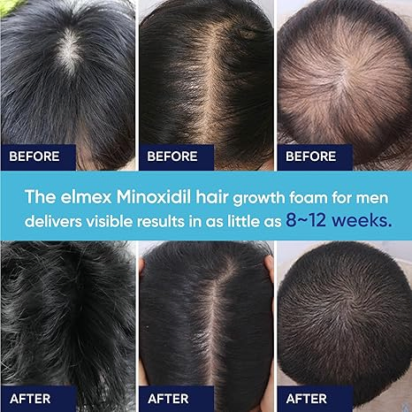 Fabricante de espuma tópica de minoxidil de marca propia 5