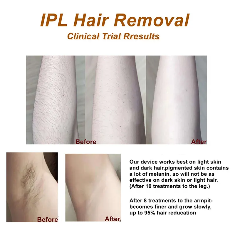 Wholesale Ipl Ice Cool Hair Removal Mismon Brand 4