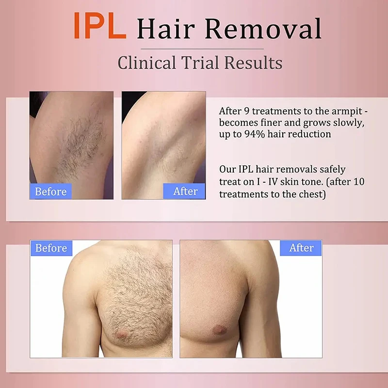 Mga Manufacturer ng Custom na Ipl Hair Removal Equipment Manufacturer 5