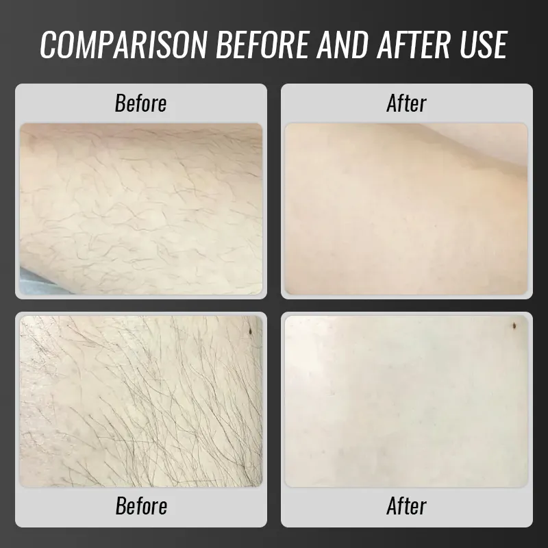 Portable 808 Diode Laser Hair Removal Machine Manufacturer 7