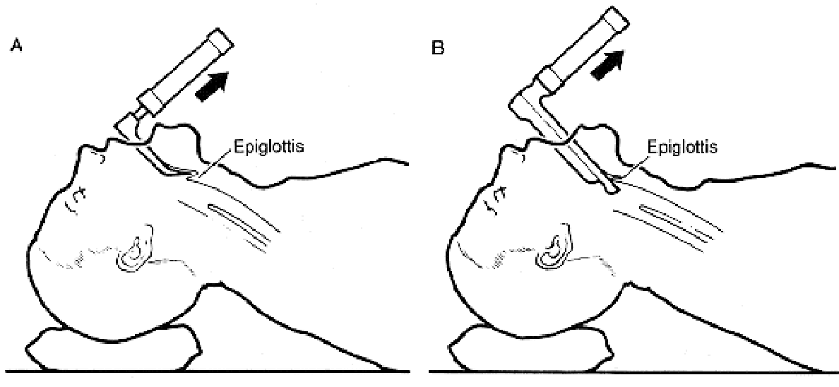Tracheal Intubation and Airway Management
