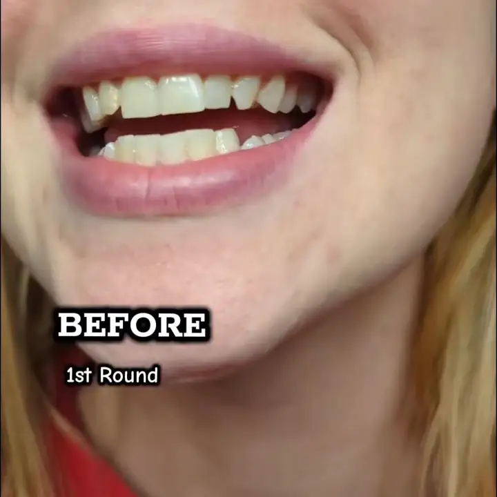 Purple correction teeth whitening strip 1