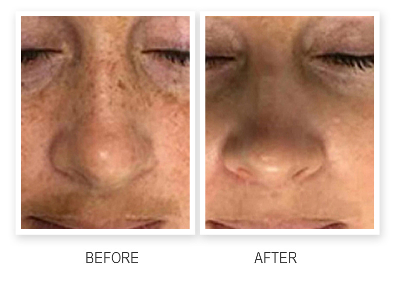 eliminación de pigmento