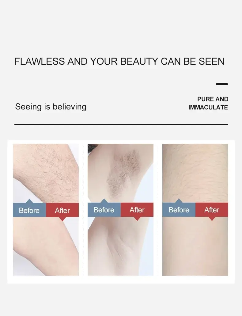 Laser Hair Removal System Video Technical Support AC400-700nm 7