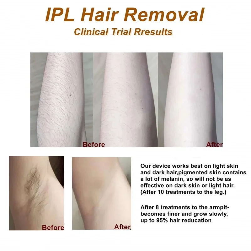 ម៉ាស៊ីនដកសក់ឡាស៊ែរ Ipl ដែលអាចទុកចិត្តបាន តម្លៃ AU អ្នកផ្គត់ផ្គង់ 6