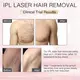 ឧបករណ៍ដកសក់ Ipl ល្អបំផុត IPL Hair Removal NOmanufacturers 6