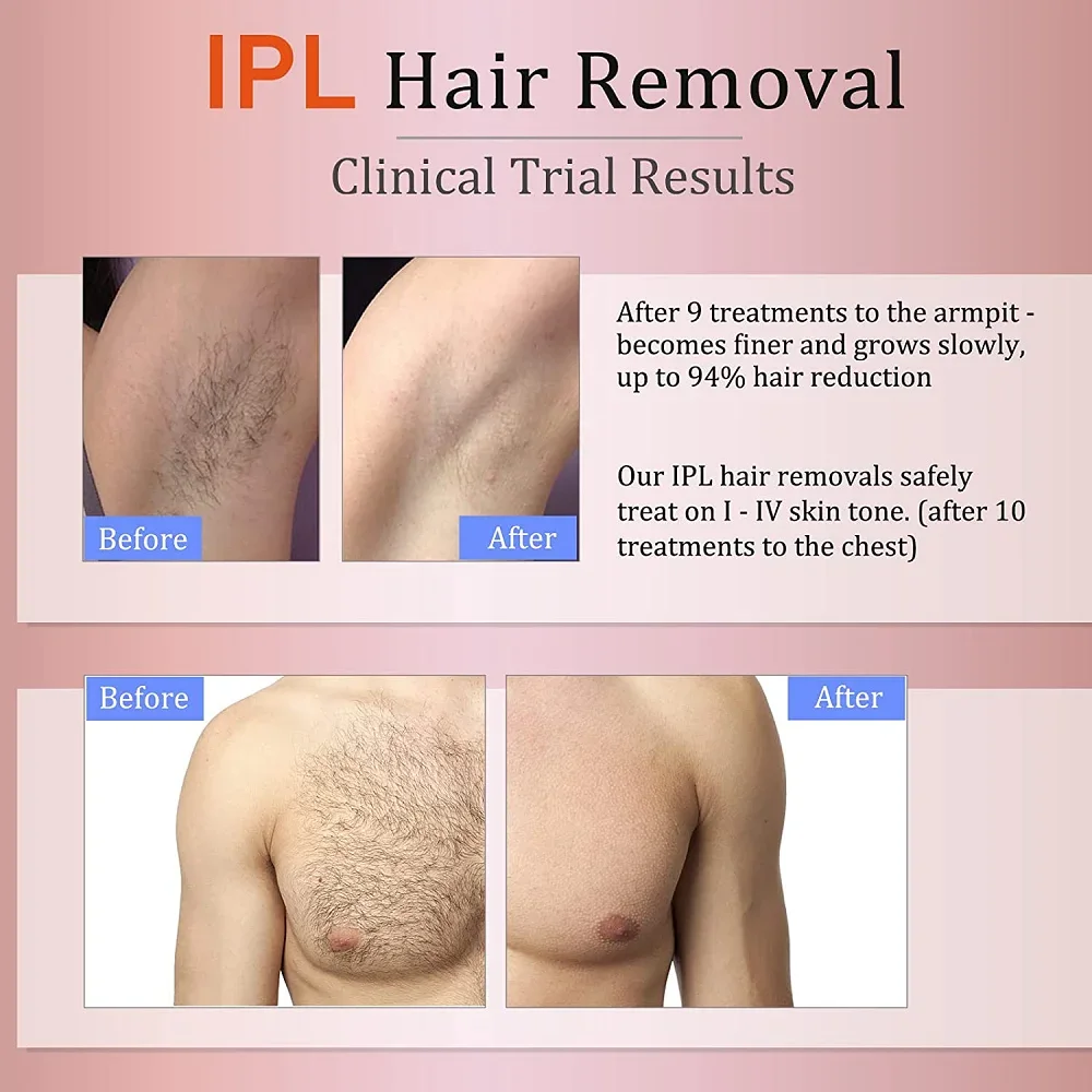 Ipl Machine Manufacturers IPL Laser Hair Removal Machine Avanoamakers 7