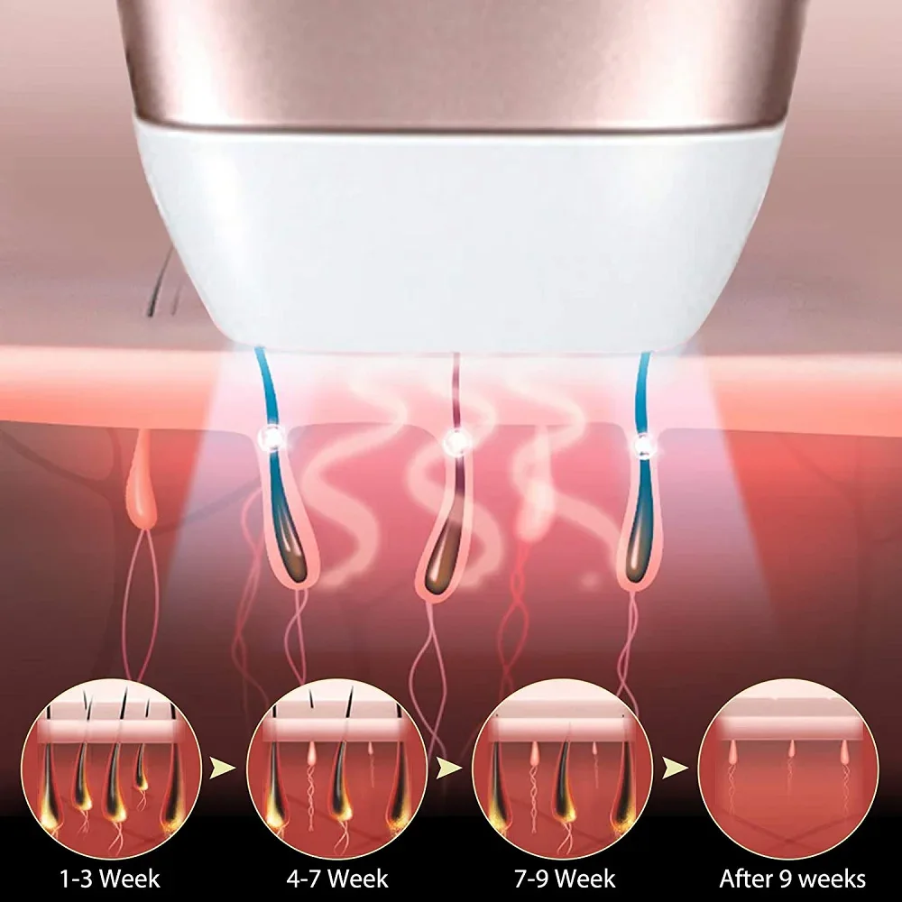 هول سيل Ipl وار هٽائڻ واري ڊيوائس ڪمپني 7