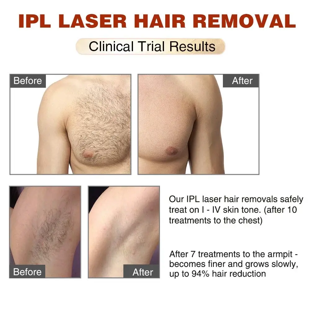 Ipl Equipment Suppliers Mismon ბრენდი 10-15J დიახ 6