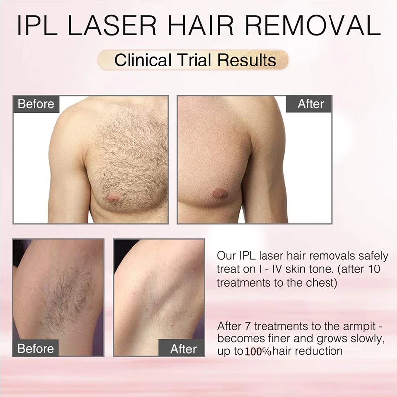 I-Mismon Laser yokuSuswa kweNwele inkqubo-1 6