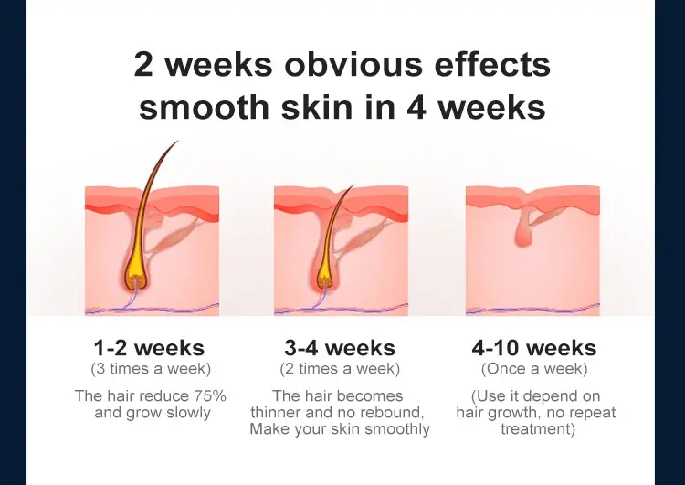 Sapphire Ipl Hair Removal Company Hair Removal 4