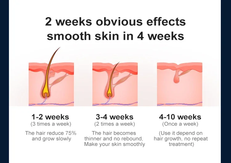 Sapphire Ipl Hair Removal Company háreyðing 4