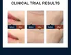 Sapphire Ipl Hair Removal Company Hair Removal 5