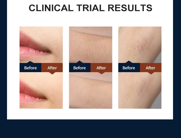 Sapphire Ipl Hair Removal Company háreyðing 5