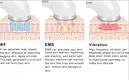 Reliable Multi Function Hair Removal Machine Price List 6