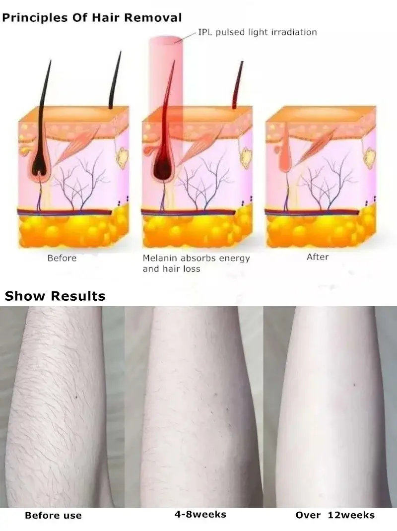 High-end Ipl Hair Removal Equipment Manufacturer Makers 6