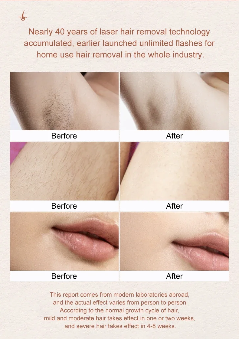 Laser Hair Removal System Factory 110-240V 5