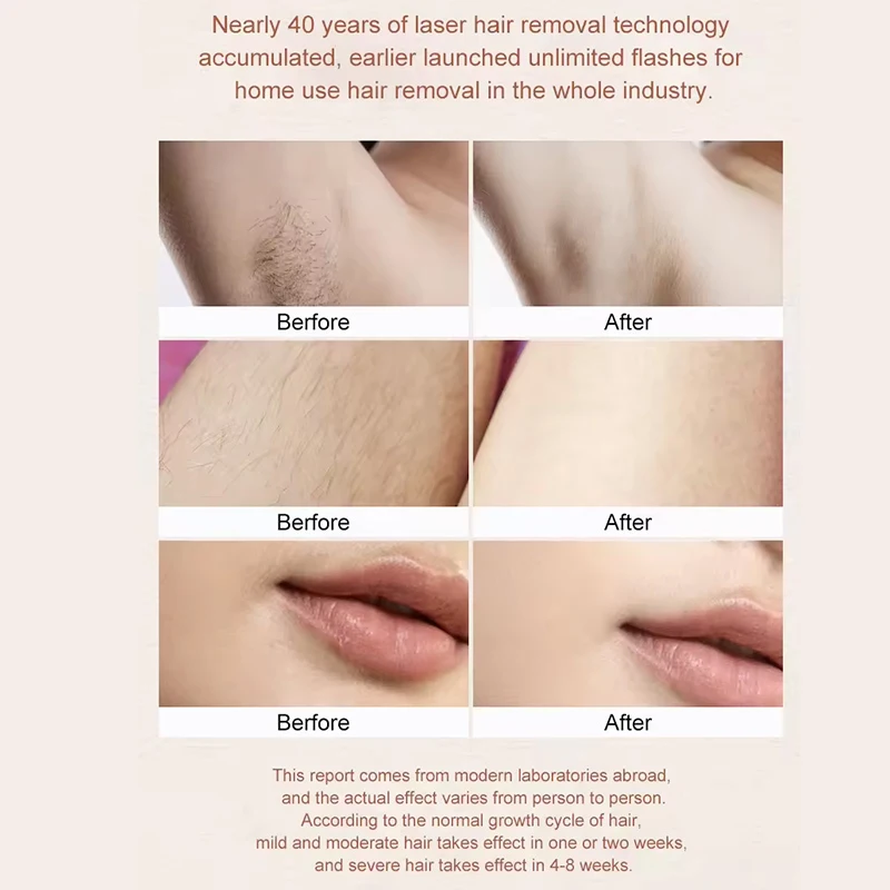 Kosten-effektyf Ipl Hair Removal Machine Fabrikant Suppliers 5