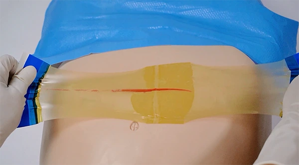 Sterile PU Iodine Incise Dressing for surgery with handle 11