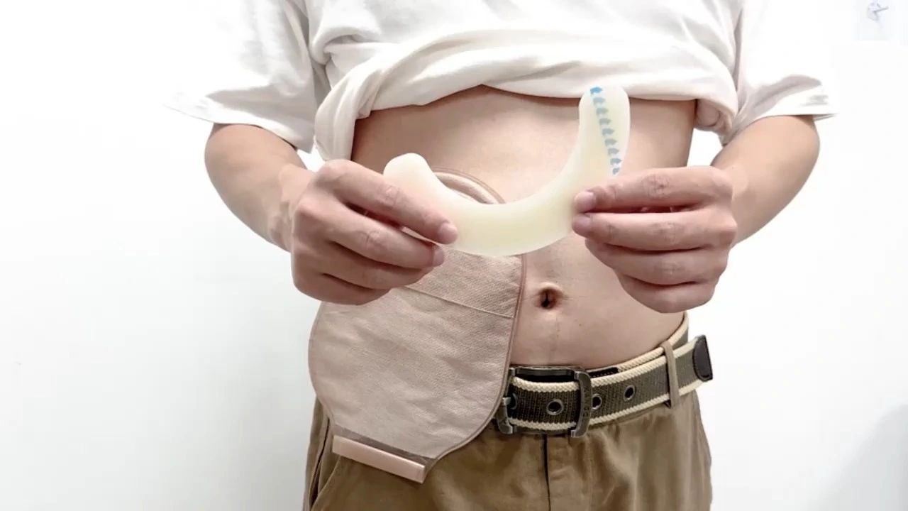 Ostomy Barrier Strips - Medical Grade Hydrocolloid Waterproof Leak - Skin Adhesive Ostomy Barrier Tape for Colostomy Stoma Bags 1