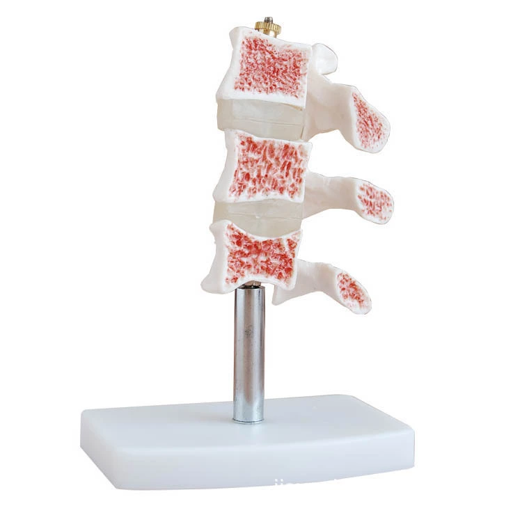 Osteoporosis seccionada | INNORKOM 1