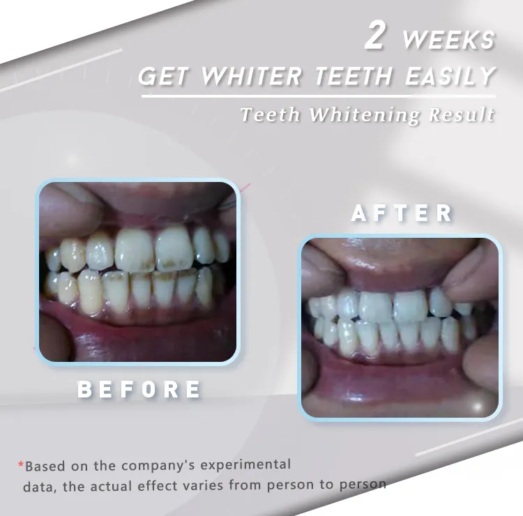 GlorySmile Custom high quality professional effects whitestrips for business for teeth 4