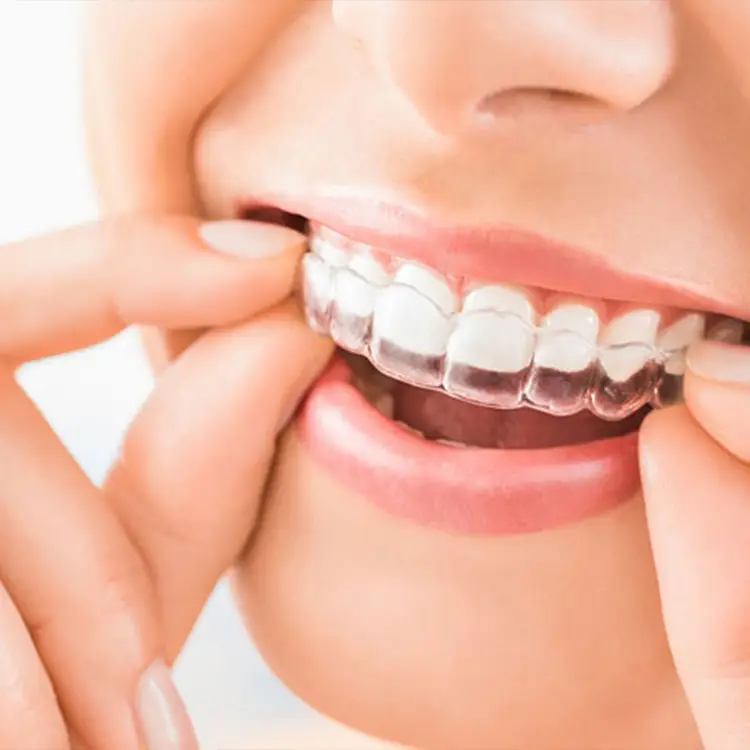 Glorysmile Transparent Aligners Invisible Orthodontics Braces OEM Cheap Adult With Box 1