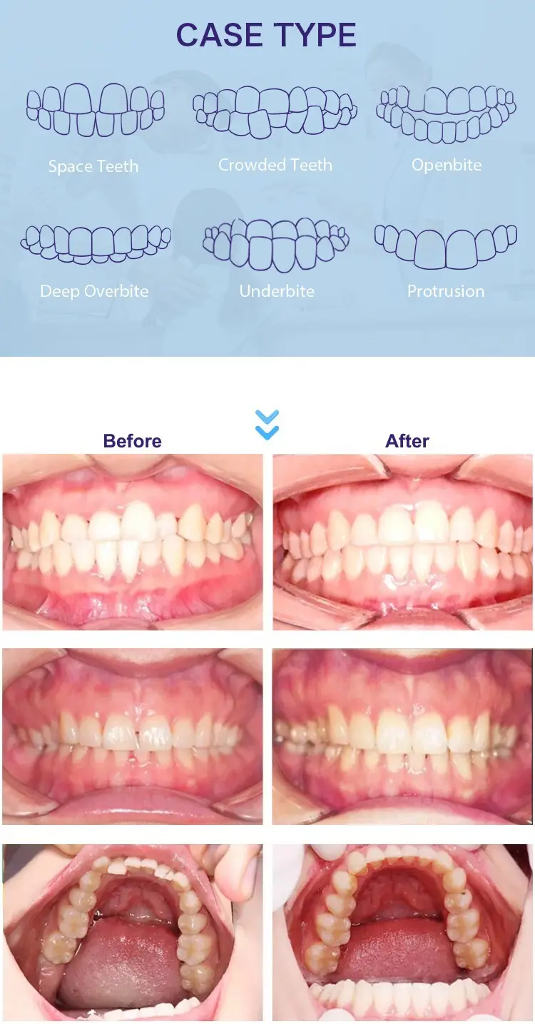 GlorySmile best clear teeth aligners company for whitening teeth 6