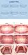 GlorySmile best clear teeth aligners company for whitening teeth 6