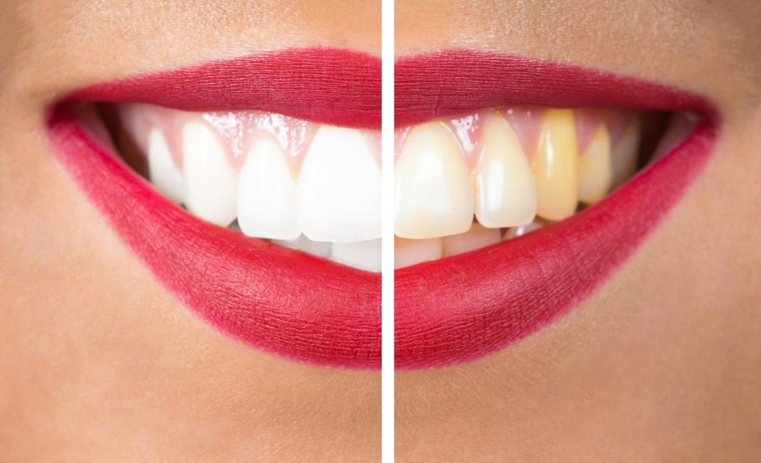 womans teeth before and after whitening