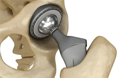 Medical Titanium Alloy Parts